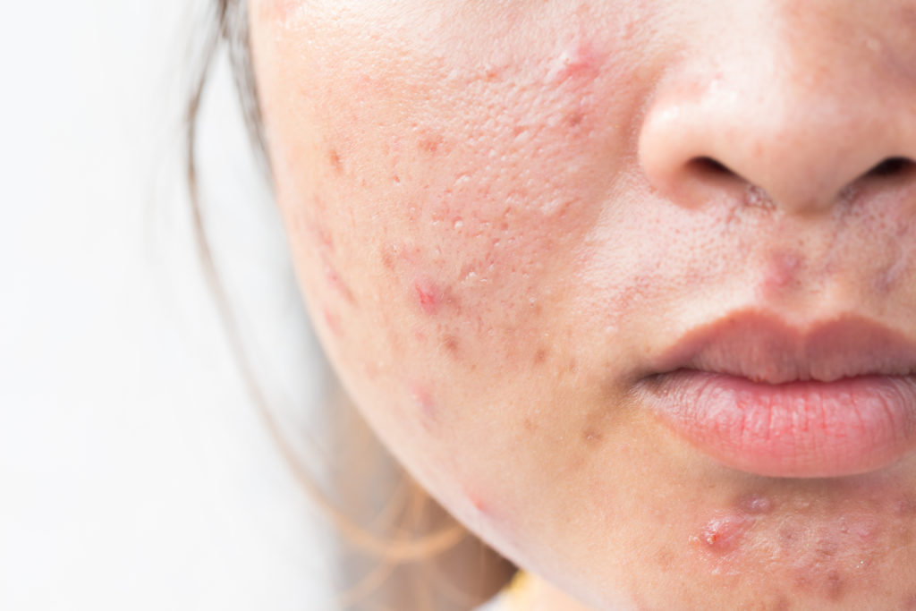 acne after birth control