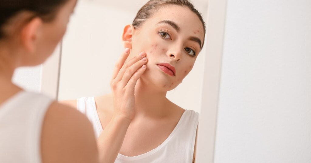 pcos and pimples