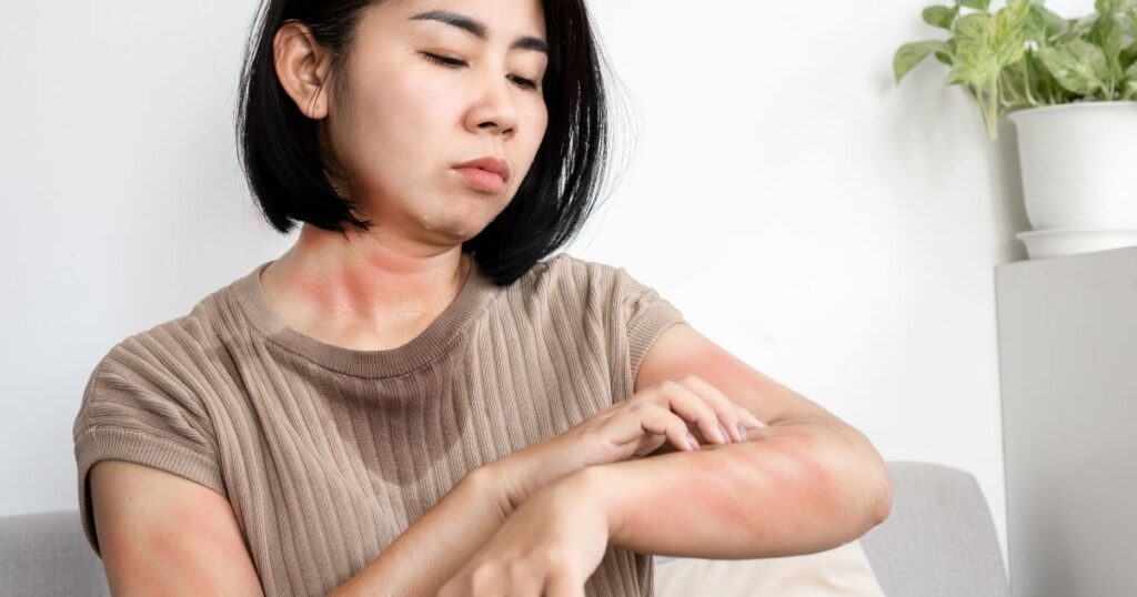 histamine intolerance reaction