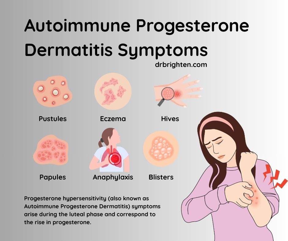 progesterone dermatitis